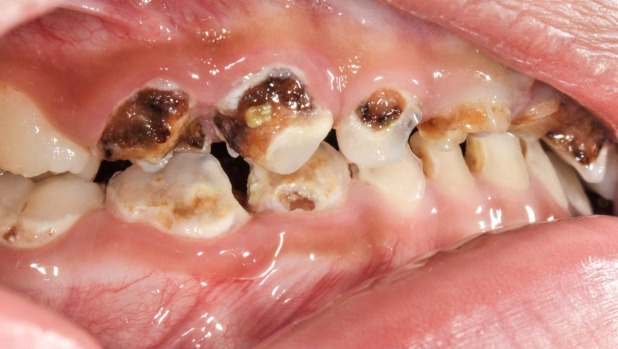 Tooth decay is harming children in a fluoridated area?!